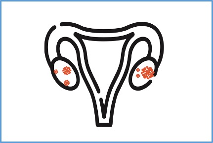 Homo sapiens / Ovarian Cancer
